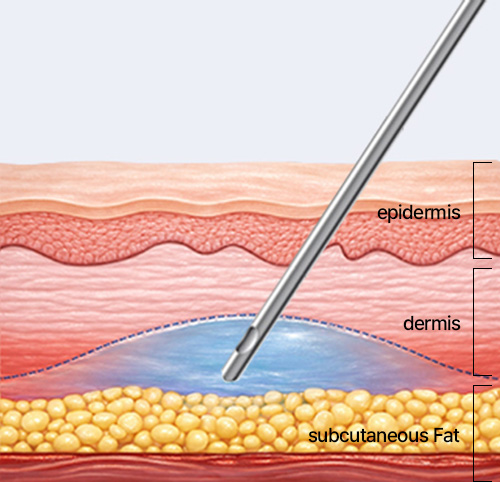 캐눌라 시술 이미지