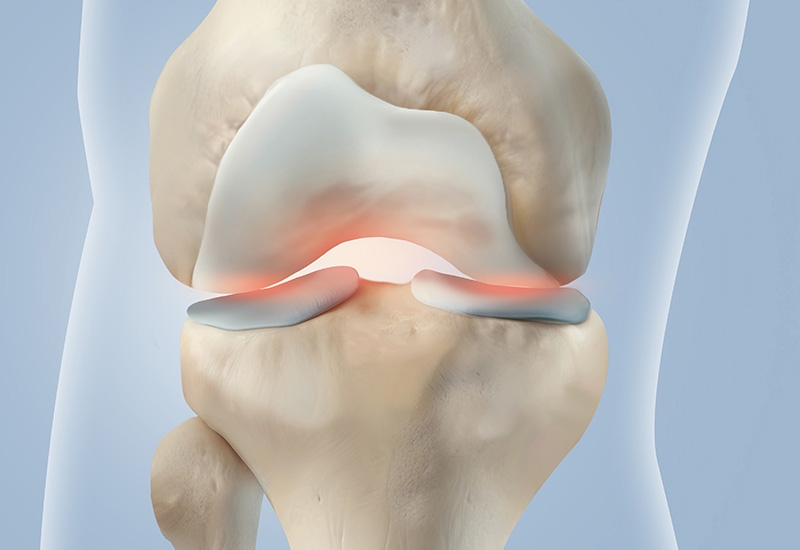 연골 손상·관절염